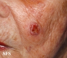 squamous cell carcinoma