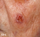 squamous cell carcinoma