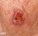 squamous cell carcinoma