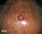 squamous cell carcinoma