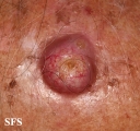 squamous cell carcinoma