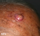 squamous cell carcinoma