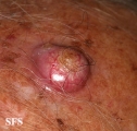 squamous cell carcinoma