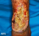 squamous cell carcinoma