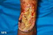 squamous cell carcinoma