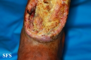 squamous cell carcinoma