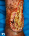 squamous cell carcinoma