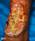 squamous cell carcinoma