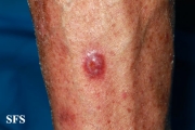 squamous cell carcinoma