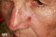 squamous cell carcinoma