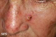 squamous cell carcinoma