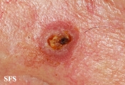 squamous cell carcinoma