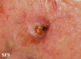 squamous cell carcinoma
