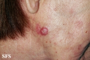 squamous cell carcinoma