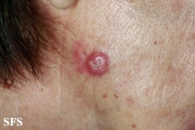 squamous cell carcinoma