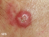 squamous cell carcinoma