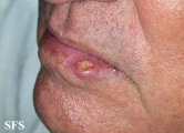 squamous cell carcinoma