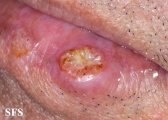 squamous cell carcinoma