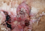squamous cell carcinoma