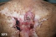 squamous cell carcinoma