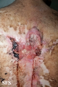 squamous cell carcinoma
