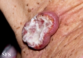 squamous cell carcinoma