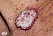 squamous cell carcinoma