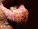 squamous cell carcinoma