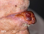 squamous cell carcinoma