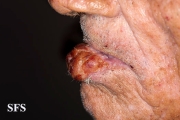 squamous cell carcinoma