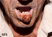 squamous cell carcinoma
