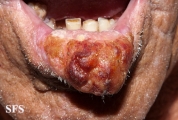 squamous cell carcinoma
