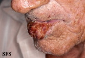 squamous cell carcinoma
