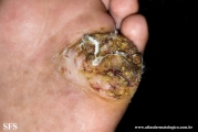 squamous cell carcinoma