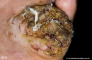 squamous cell carcinoma