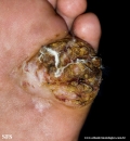 squamous cell carcinoma
