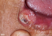 squamous cell carcinoma