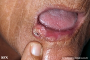 squamous cell carcinoma