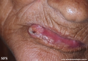 squamous cell carcinoma