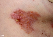 hailey-hailey disease