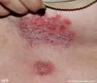 hailey-hailey disease