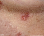 hailey-hailey disease
