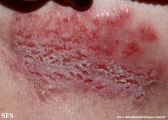 hailey-hailey disease