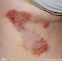 hailey-hailey disease