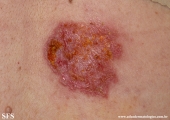 hailey-hailey disease