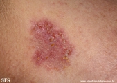 hailey-hailey disease