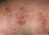 hailey-hailey disease