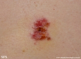 hailey-hailey disease