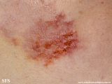 hailey-hailey disease