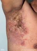 hailey-hailey disease